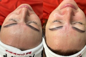 Дидимова Виктория Петровна — Комбинированная чистка лица — Портфолио №6