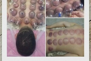 Гасюль Ольга Григорьевна — Защемление седалещного нерва — Портфолио №17