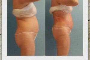 Гасюль Ольга Григорьевна — Лечение воспаления седалещного нерва, с помощью вакуумных банок! — Портфолио №18