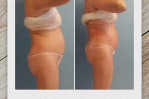 Гасюль Ольга Григорьевна — Коррекция овала лица — Портфолио №21