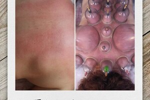 Гасюль Ольга Григорьевна — Шейно-воротниковая зона ,грудной отдел — Портфолио №22