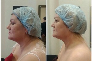 Гасюль Ольга Григорьевна — Коррекция фигуры на препарате Целое! Результат после 1 сеанса! Минус 6 см! — Портфолио №30