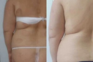 Гасюль Ольга Григорьевна — Результат после одной процедуры на Мегаскульпторе Целое! — Портфолио №32