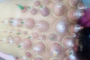 Гасюль Ольга Григорьевна — Постановка вакуумных банок на живот и грудной отдел — Портфолио №37