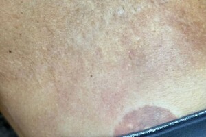 Хасанова Елена Павловна — Заживший камуфляж спустя 2 месяца перед обновлением — Портфолио №1