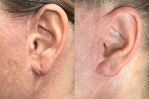 Хасанова Елена Павловна — Камуфляж рубцов после подтяжки — Портфолио №5