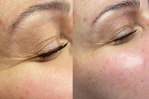 Ким Наталья Борисовна — Процедура жидкий лазер! Абсолютно безболезненно. Система 3 Д реконструкции матрикса даёт потрясающие результаты после... — Портфолио №4