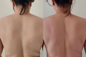 Коваленко Ольга Анатольевна — Результат после двух сеансов,по два часа на каждую сторону. — Портфолио №1