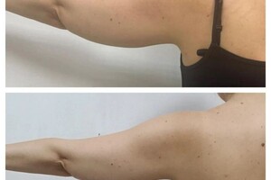 Коваленко Ольга Анатольевна — Проработка рук,результат после одного сеанса.1час — Портфолио №4