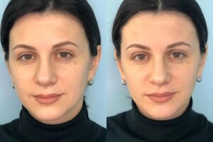 Коваленко Ольга Анатольевна — Результат после первого сеанса.; Уменьшение отёчности; Подтянулся овал лица; Уменьшилась ассиметрия лица — Портфолио №5