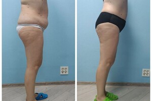 Коваленко Ольга Анатольевна — Проведен курс антицеллюлитного массажа из 10 сеансов — Портфолио №6