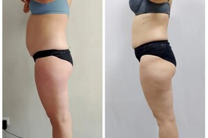 Коваленко Ольга Анатольевна — Проведено три сеанса:; один сеанс на зону живота длительностью в два часа; Два сеанса на зону боков спины и талии... — Портфолио №7