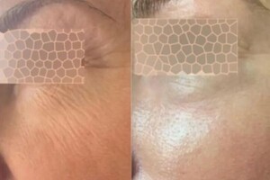 Лобкова Ирина Александровна — Лифтинг лица,уменьшение глубины морщин,сияние кожи. — Портфолио №4