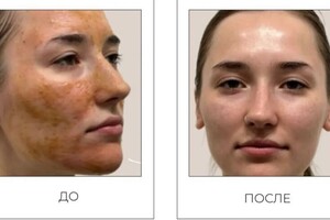 Лобкова Ирина Александровна — Удаляет омертвевшие клетки,выравнивает цвет лица,убирает пигментацию,насыщает кожу кислородом,делает кожу ровной и... — Портфолио №5