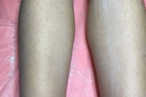 Максимова Ольга Анатольевна — Удаление воском работа до,после не успела сфотографировать — Портфолио №38