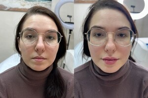 Олешко Евгения Михайловна — Контурная пластика губ — Портфолио №3