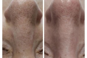 Беляевская Яна Вячеславовна — Чистка лица — Портфолио №4