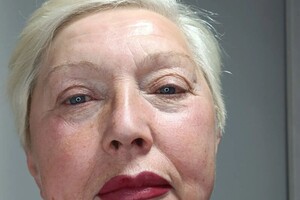 Перевалова Ирина Михайлова — Сразу после процедуры моя модель — Портфолио №4