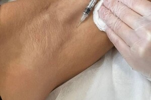 Самохвалова Алиса Алексеевна — Лечение гипергидроза (потливости) — Портфолио №92