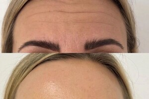 Самохвалова Алиса Алексеевна — Иммобилизирующая процедура для разглаживания мимических морщин — Портфолио №93