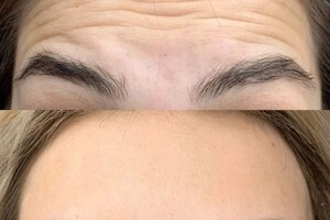 Самохвалова Алиса Алексеевна — Иммобилизирующая процедура для разглаживания мимических морщин — Портфолио №94