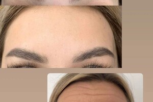 Самохвалова Алиса Алексеевна — Иммобилизирующая процедура для разглаживания мимических морщин — Портфолио №97