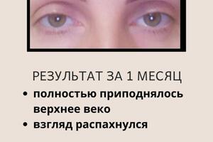 за 7 дней подтянулось верхнее веко — Сидорина Татьяна Сергеевна