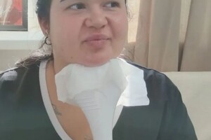 Сухомлинова Елена Владимировна — Устранение второго подбородка, методом криолиполиз — Портфолио №5