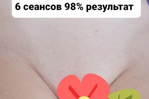 Сухомлинова Елена Владимировна — Удаление нежелательных, волос в зоне глубокое бикини — Портфолио №6