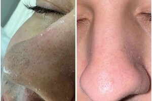 Сухомлинова Елена Владимировна — Чистка лица; Что входит:; очищение; холодное гидрирование (распаривание); Ультразвуковая чистка; Вакуумный... — Портфолио №8