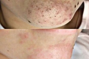 Янда Оксана Михайловна — Комбинированная чистка лица — Портфолио №1