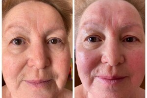 Янда Оксана Михайловна — Миофасциальный массаж лица — Портфолио №5