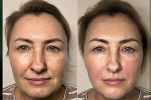 Янда Оксана Михайловна — Авторский массаж лица + карбокситерапия — Портфолио №9