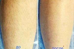 Залееская Анастасия Борисовна — Шугаринг ног — Портфолио №2