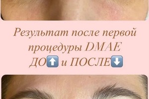 DMAE Active concentrate (диметиламиноэтанол); ?Результат применения:; *Лифтинг-концентрат мгновенно подтягивает... — Григорян Елена Арменовна