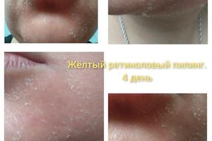 Жёлтый, ретиноловый пилинг. Шелушение на 4 день. Пилинг Mediderma, 3ST- Retisess yellow peel. Шелушение самое активное... — Лемещенко Наталья Александровна