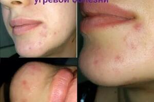 Результат после первого процедура — Алексанян Ирина Геворговна