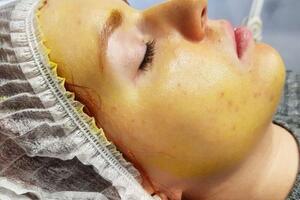 Жёлтый пилинг — Ларукова Елена Ильинична