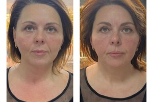 Курс из 6 процедур миофасциального массажа лица. Также 2 раза применяли Буккальные техники. — Малюшова Наталья Вадимовна