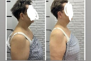 Произведена работа с шеей и декольте. Результат с одного массажа лица — Малюшова Наталья Вадимовна