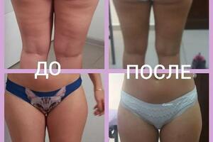Результат за 8 сеансов. Минус 3 см в бедрах, 2 см в талии; Минус 2 кг — Шайнога Жанна Игоревна