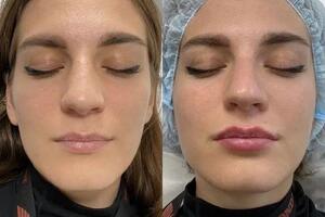 Контурная пластика губ препаратом Juvederm Ultra 1 ml — Хабибуллин Руслан Игоревич