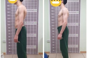 Лушникова Анастасия Викторовна — Коррекция сколиоза — Портфолио №3