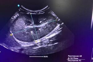 Полный разбор заключения УЗИ — Цыбанёва Ирина Григорьевна